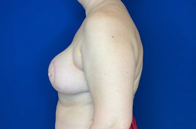Breast DIEP Flap Reconstruction Before & After Gallery - Patient 144437 - Image 6