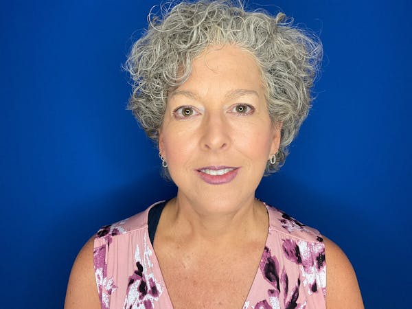 Facelift Before & After Gallery - Patient 224632 - Image 2