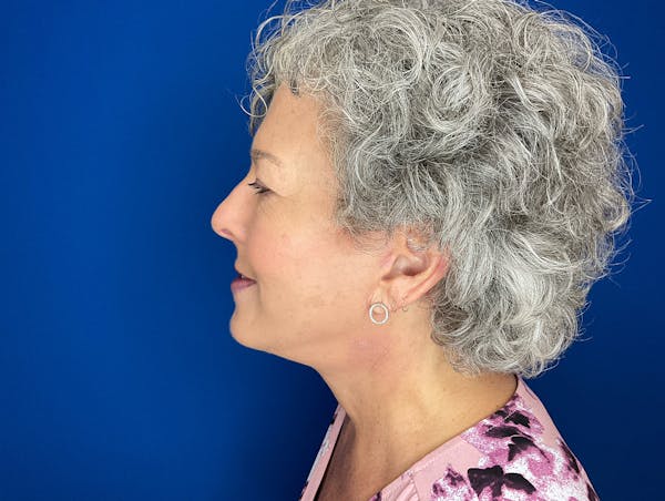 Facelift Before & After Gallery - Patient 224632 - Image 6