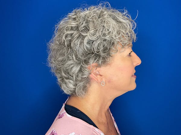 Facelift Before & After Gallery - Patient 224632 - Image 4