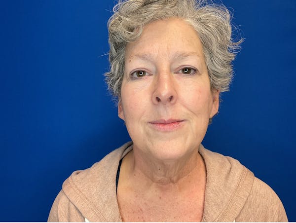 Facelift Before & After Gallery - Patient 224632 - Image 1