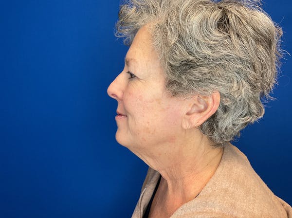 Facelift Before & After Gallery - Patient 224632 - Image 5