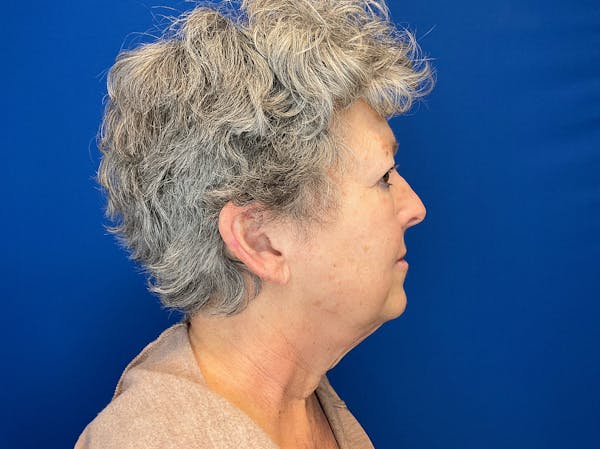 Facelift Before & After Gallery - Patient 224632 - Image 3