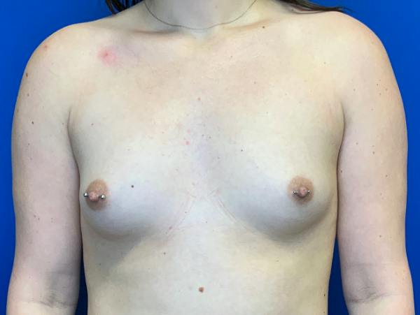 Breast Augmentation Before & After Gallery - Patient 102510 - Image 1