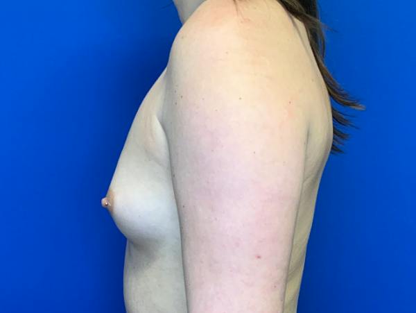 Breast Augmentation Before & After Gallery - Patient 102510 - Image 3