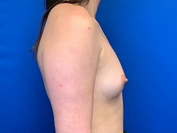 Breast Augmentation Before & After Gallery - Patient 102510 - Image 5