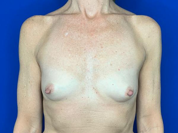 Breast Augmentation Before & After Gallery - Patient 904564 - Image 1
