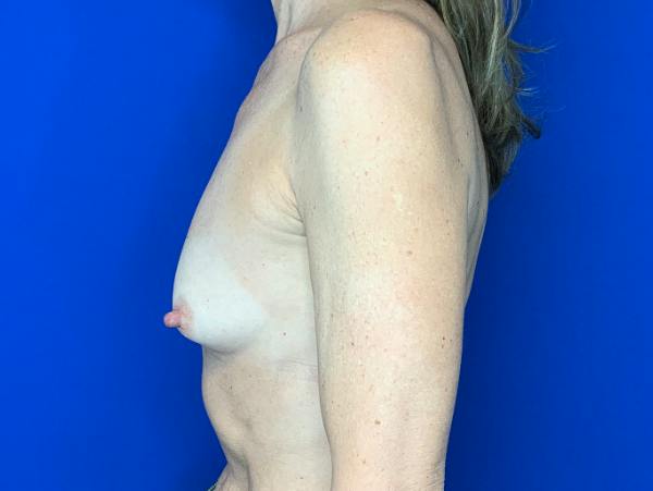 Breast Augmentation Before & After Gallery - Patient 904564 - Image 3