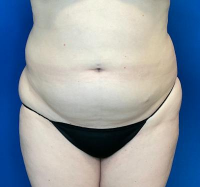 Liposuction Before & After Gallery - Patient 126816 - Image 1