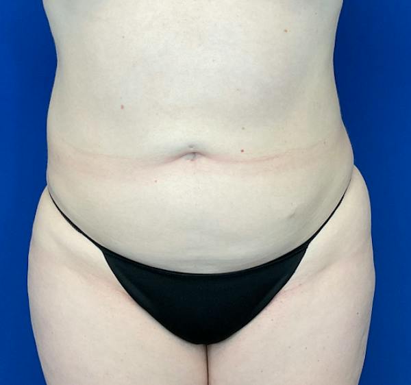 Liposuction Before & After Gallery - Patient 126816 - Image 2