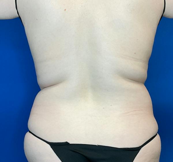 Liposuction Before & After Gallery - Patient 126816 - Image 3