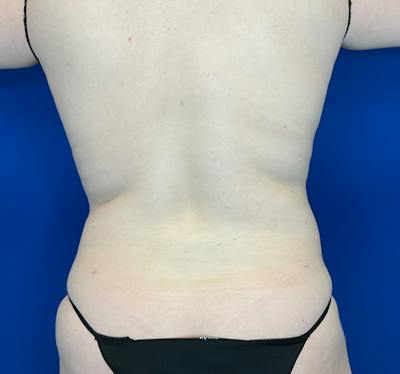 Liposuction Before & After Gallery - Patient 126816 - Image 4