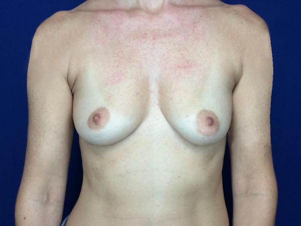 Breast Augmentation Before & After Gallery - Patient 249671 - Image 1