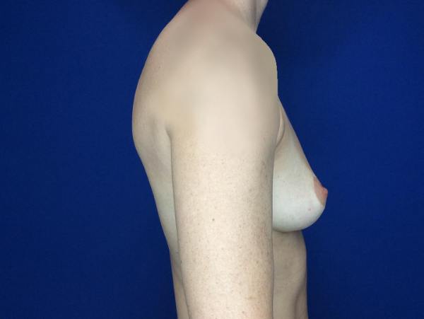 Breast Augmentation Before & After Gallery - Patient 249671 - Image 5