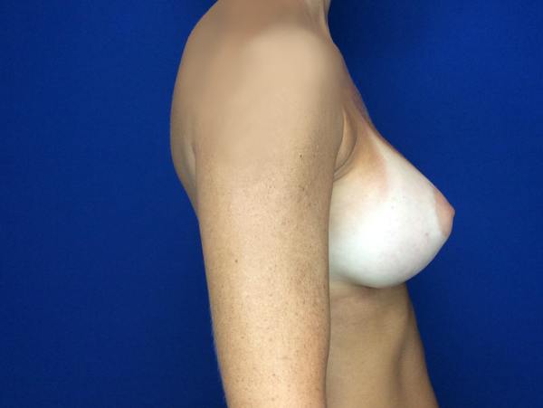 Breast Augmentation Before & After Gallery - Patient 249671 - Image 6