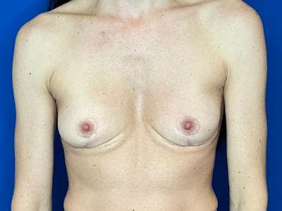Breast Implant Removal and Replacement Before & After Gallery - Patient 405833 - Image 1