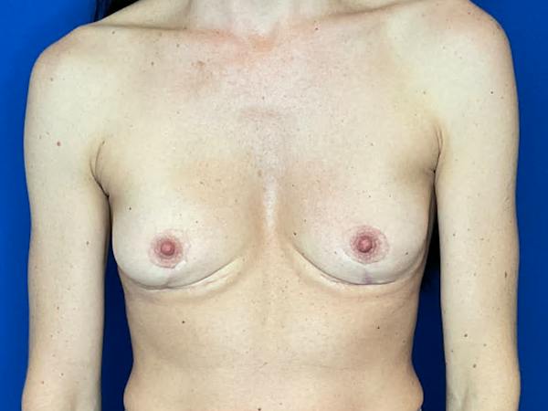 Breast Implant Removal and Replacement Before & After Gallery - Patient 405833 - Image 1