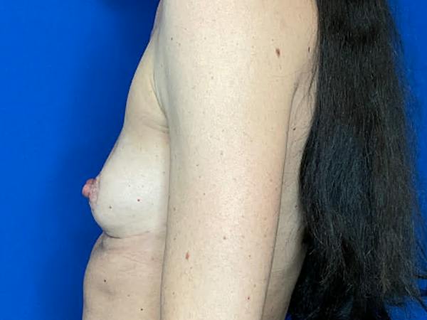 Breast Implant Removal and Replacement Before & After Gallery - Patient 405833 - Image 3