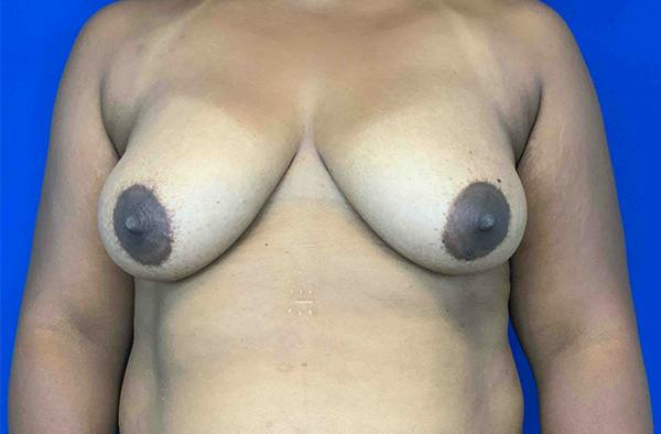 Breast DIEP Flap Reconstruction Before & After Gallery - Patient 423475 - Image 1
