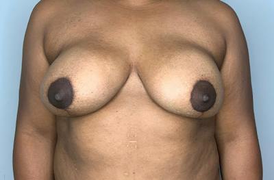 Breast DIEP Flap Reconstruction Before & After Gallery - Patient 423475 - Image 2