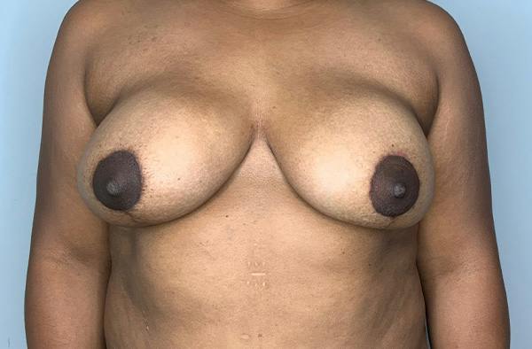 Breast DIEP Flap Reconstruction Before & After Gallery - Patient 423475 - Image 2