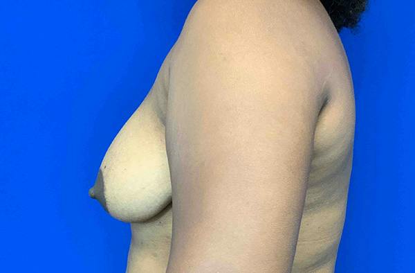 Breast DIEP Flap Reconstruction Before & After Gallery - Patient 423475 - Image 3