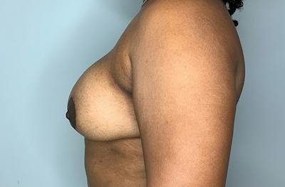 Breast DIEP Flap Reconstruction Before & After Gallery - Patient 423475 - Image 4