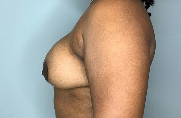 Breast DIEP Flap Reconstruction Before & After Gallery - Patient 423475 - Image 4