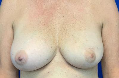 Breast DIEP Flap Reconstruction Before & After Gallery - Patient 397159 - Image 1