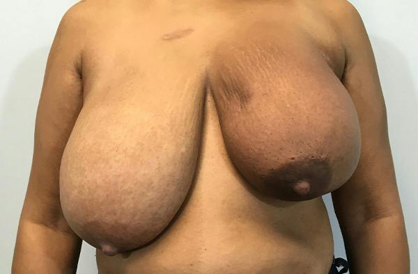 Breast DIEP Flap Reconstruction Before & After Gallery - Patient 129848 - Image 1