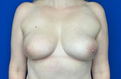Breast DIEP Flap Reconstruction Before & After Gallery - Patient 411855 - Image 2