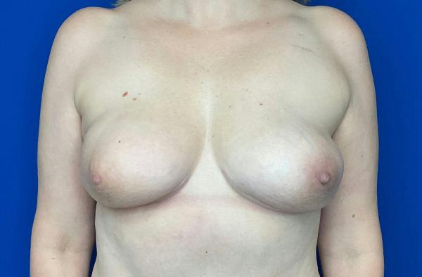 Breast DIEP Flap Reconstruction Before & After Gallery - Patient 411855 - Image 2