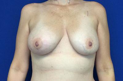 Breast DIEP Flap Reconstruction Before & After Gallery - Patient 354614 - Image 1