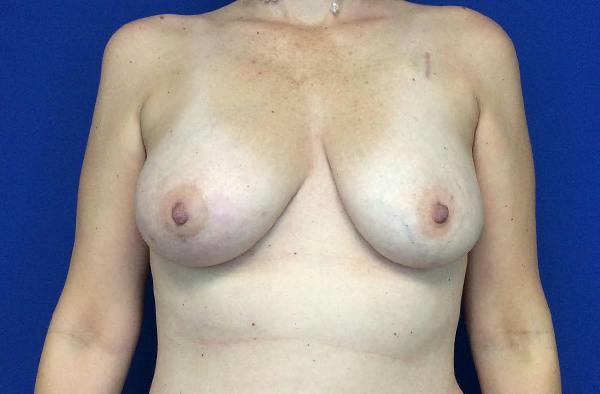 Breast DIEP Flap Reconstruction Before & After Gallery - Patient 354614 - Image 1