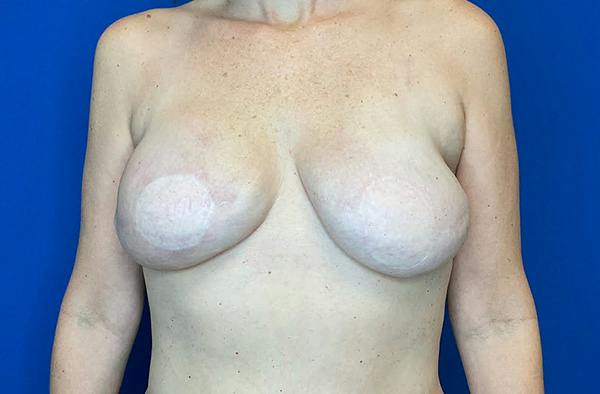 Breast DIEP Flap Reconstruction Before & After Gallery - Patient 354614 - Image 2