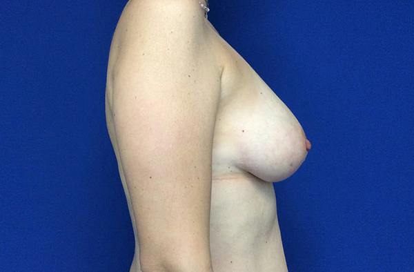 Breast DIEP Flap Reconstruction Before & After Gallery - Patient 354614 - Image 3