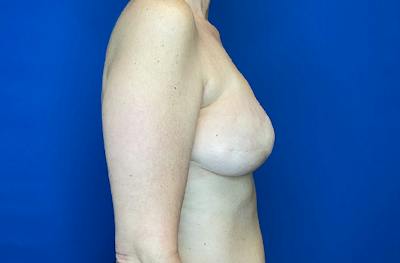 Breast DIEP Flap Reconstruction Before & After Gallery - Patient 354614 - Image 4