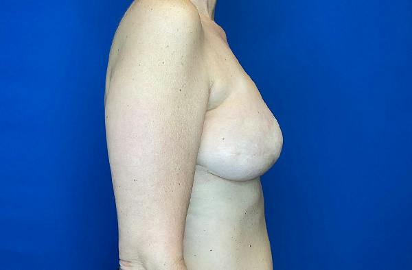 Breast DIEP Flap Reconstruction Before & After Gallery - Patient 354614 - Image 4