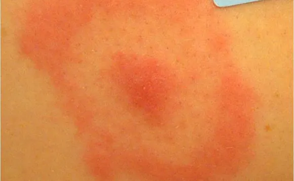 Erythema migrans