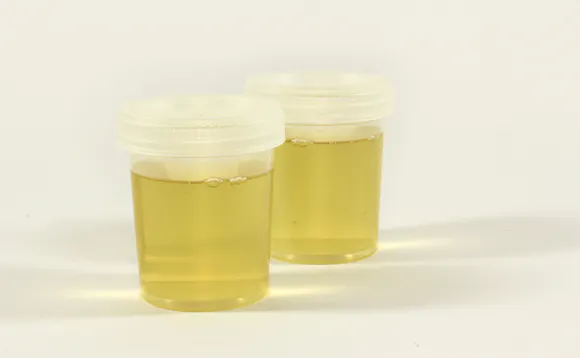 Urinprøve - blod i urinen Urinprøve - blod i urinen