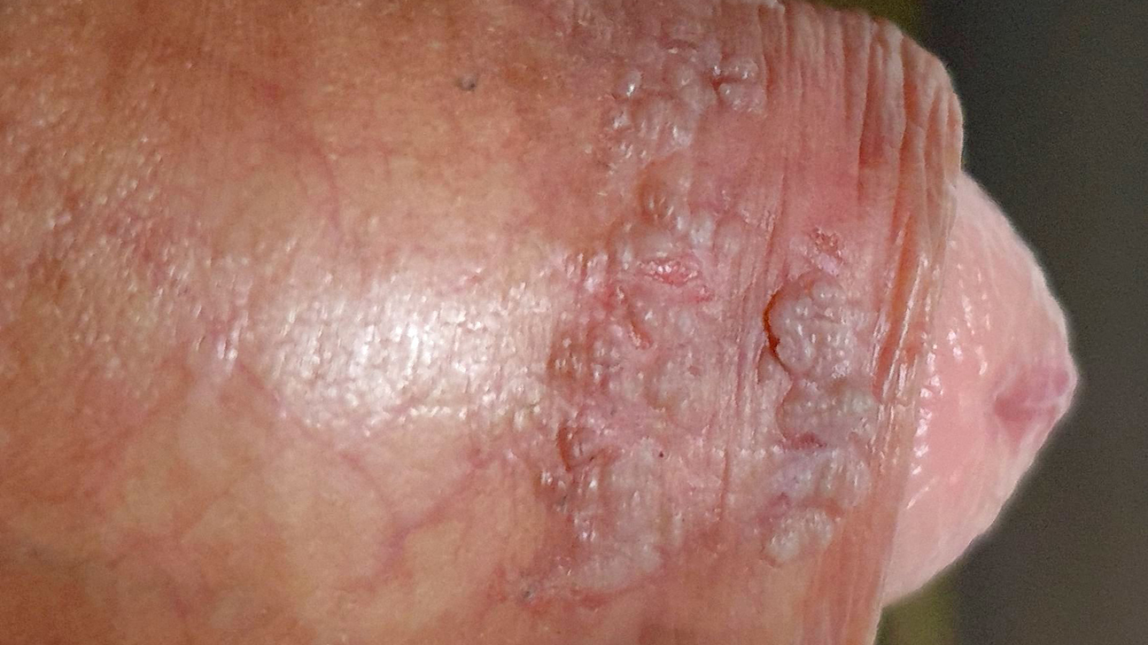 Kjønnsvorter på penis