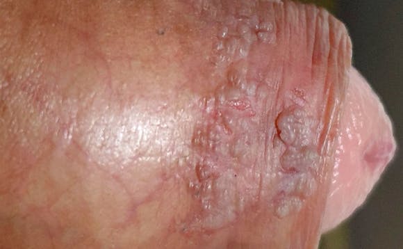 Kjønnsvorter på penis