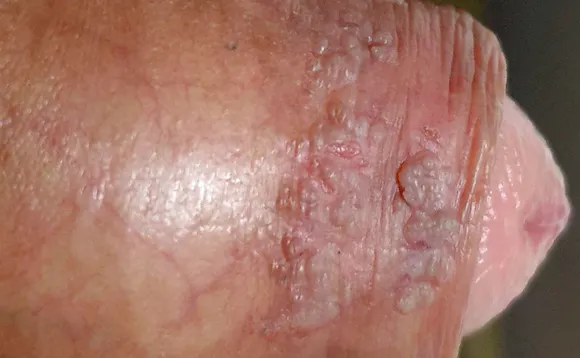 Kjønnsvorter på penis