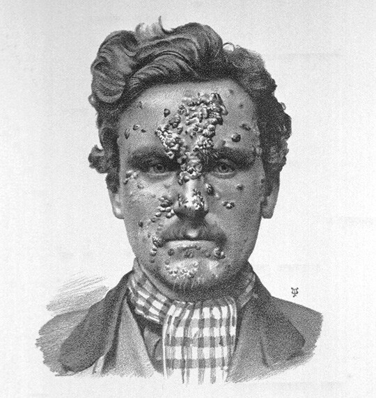 Syfilis - den verste kjønnssykdommen?