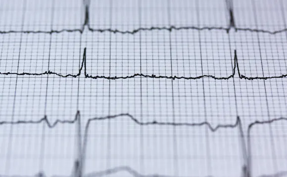 EKG - hjerteregistrering