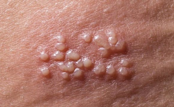 Herpes i underlivet Herpes i underlivet