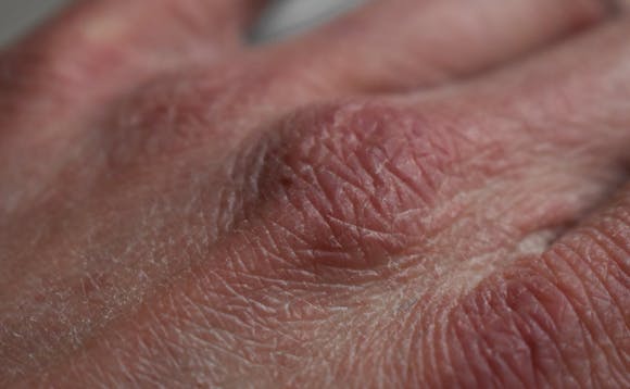 Tørr hud på hender Tørr hud på hender