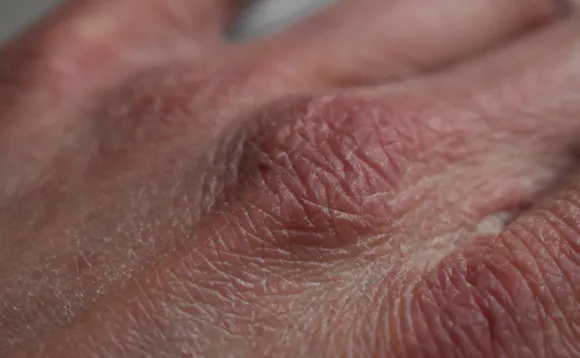 Tørr hud på hender Tørr hud på hender