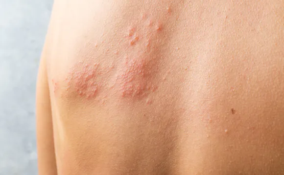 Vaksine mot helvetesild