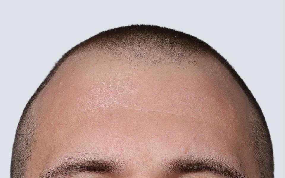 Hair Transplant Hawaii